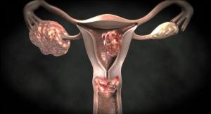 गर्भाशय ग्रीवा के कैंसर के 5 शुरुआती संकेत