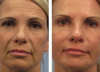 15 रूबल के लिए चेहरे और हाथों की त्वचा, रंजकता और झुर्रियों के बिना: 1 दिन उपयोग का परिणाम