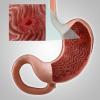Gastritis, या पेट के कटाव: मुख्य लक्षण, उपचार, आहार