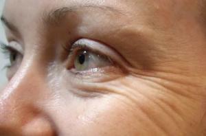 आंखों के आसपास झुर्रियाँ की उपस्थिति को रोकने के लिए