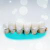 लोकप्रिय splinting दांत: कितना प्रभावी ढंग से?
