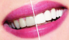 कैसे घर पर अपने दांत सफेद करने? दंत चिकित्सा सलाह।
