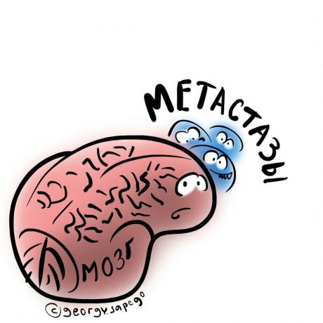 मस्तिष्क मेटास्टेसिस