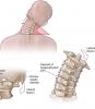 ग्रीवा रीढ़ की हड्डी के लिए 4 बुनियादी अभ्यास दर्द और osteochondrosis के बारे में भूल करने में मदद मिलेगी!