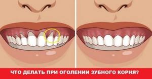 कैसे मसूड़ों के इलाज के लिए जब दांत नंगे गर्दन हो गए हैं?