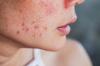 गर्मियों के बाद अपनी त्वचा को कैसे साफ करें: घरेलू और सैलून उपचार